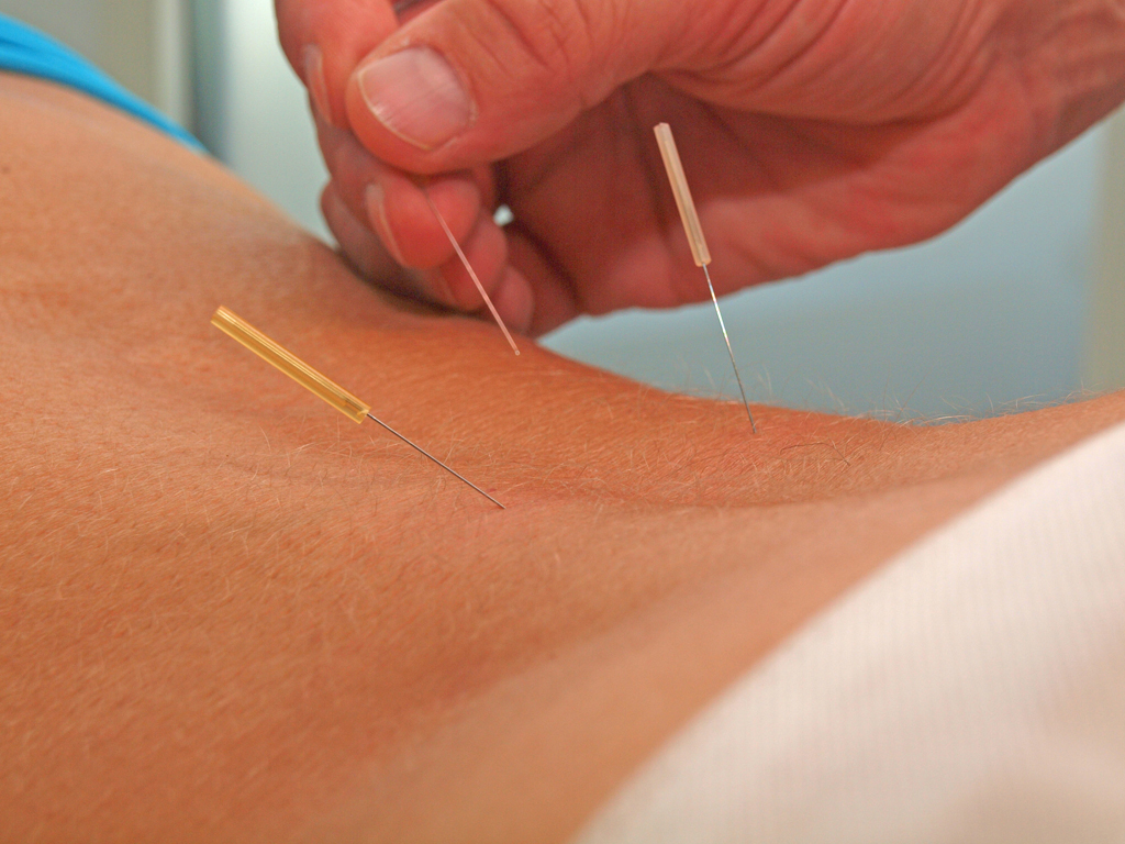 Awakening the Body: How Sunrise Acupuncture Sparks the Natural Healing Process